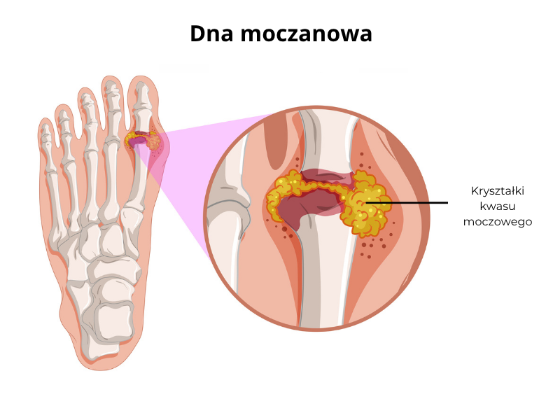 dna moczanowa