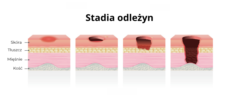 stadia odleżyn