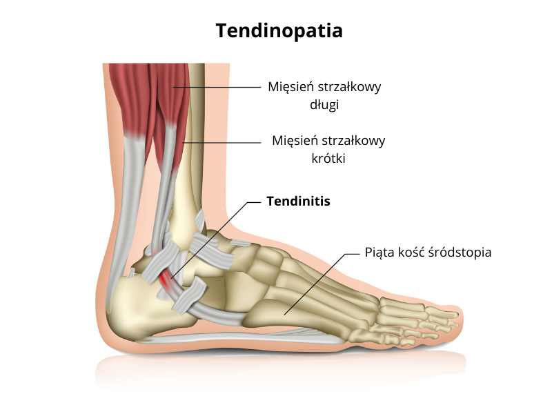 tendinopatia