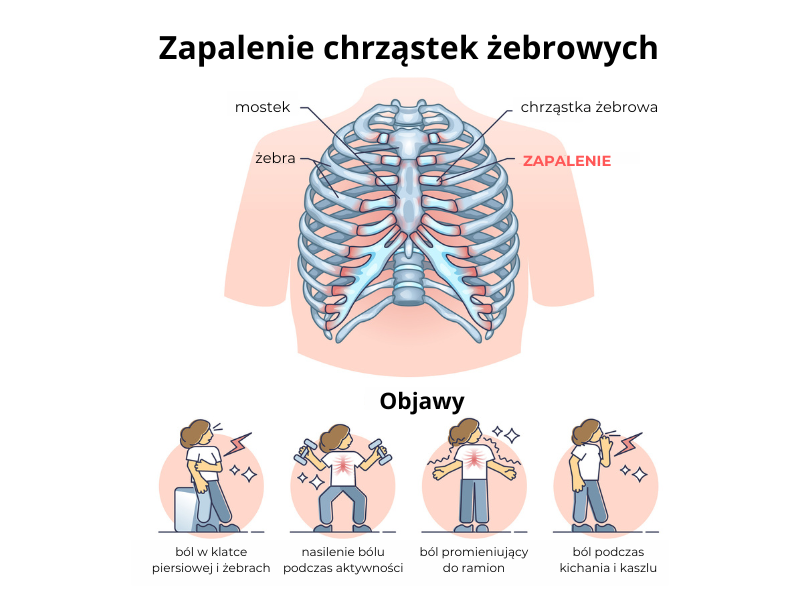 zapalenie chrząstek międzyżebrowych
