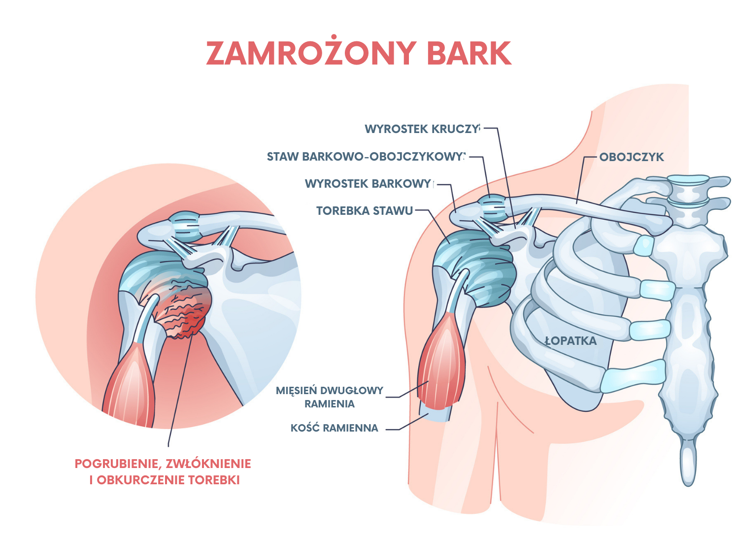 Zespół bolesnego barku