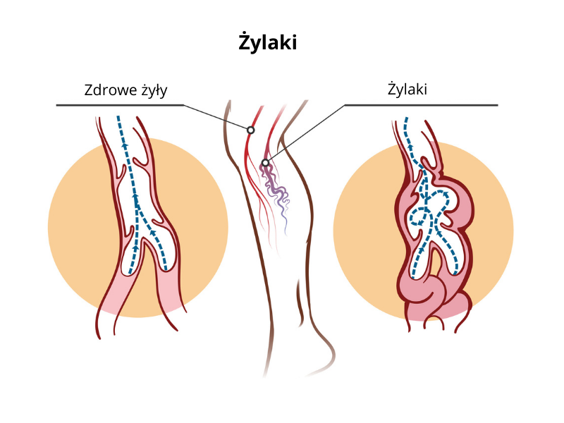żylaki