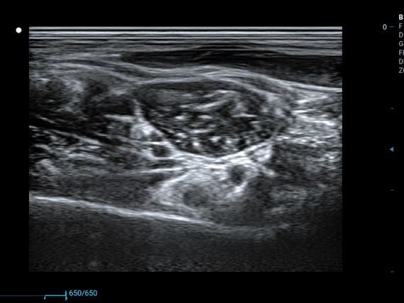 Mobilny aparat USG Zoncare M70 z głowicą convex