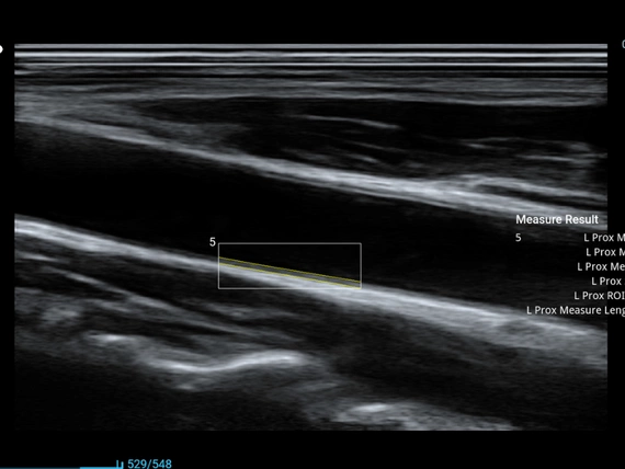 Mobilny aparat USG Zoncare M70 z głowicą liniową i convex