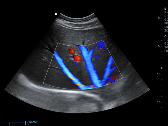 Mobilny aparat USG Zoncare M70 z głowicą liniową i convex