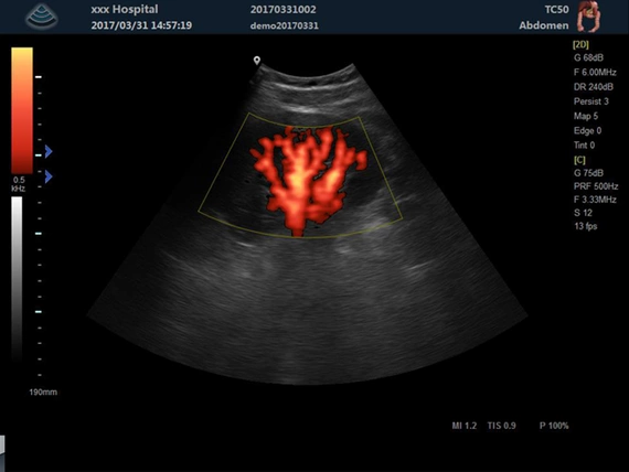 Aparat ultrasonograficzny Zoncare M5 z głowicą liniową