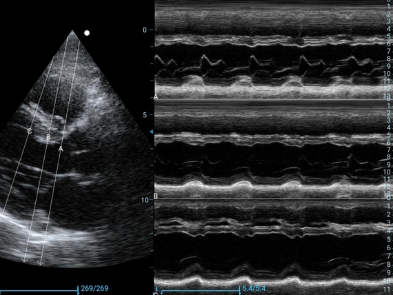 Mobilny aparat USG Zoncare M70 z głowicą liniową